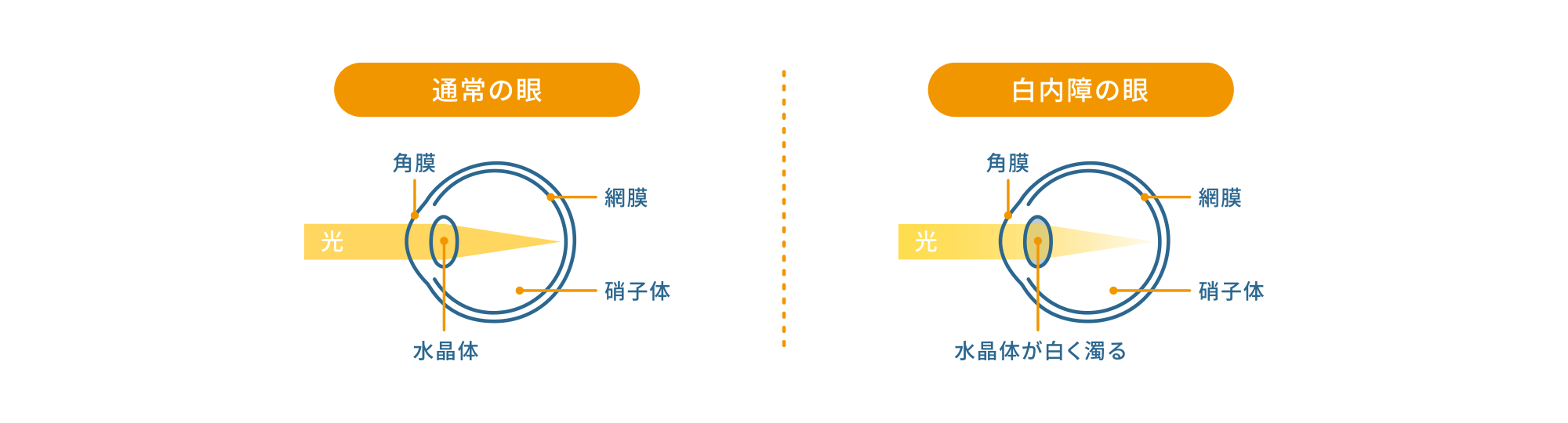 白内障の仕組み