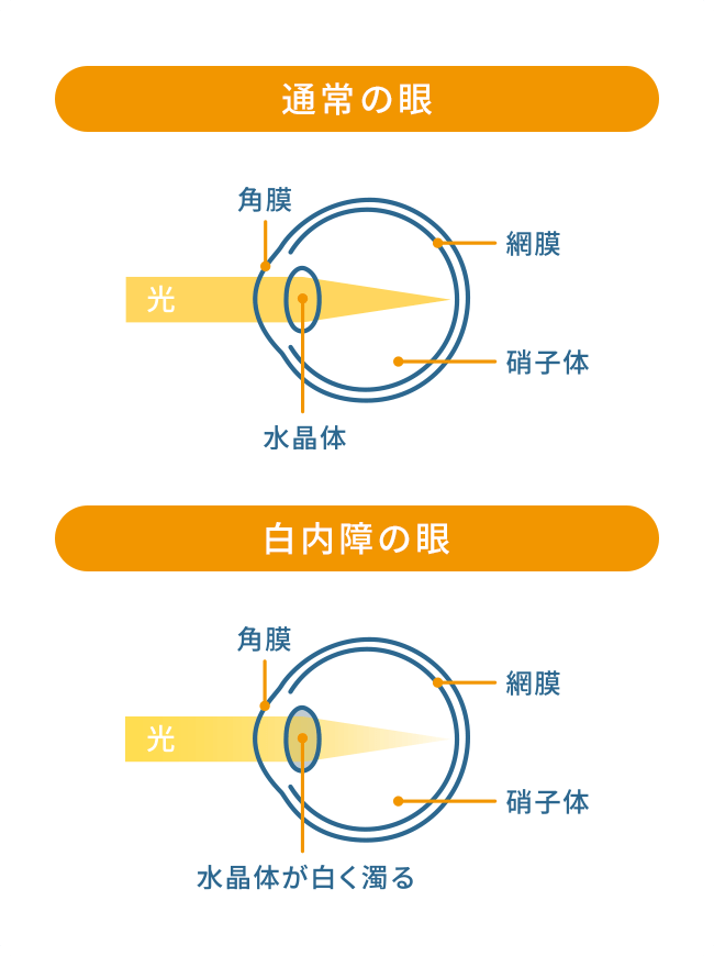 白内障の仕組み