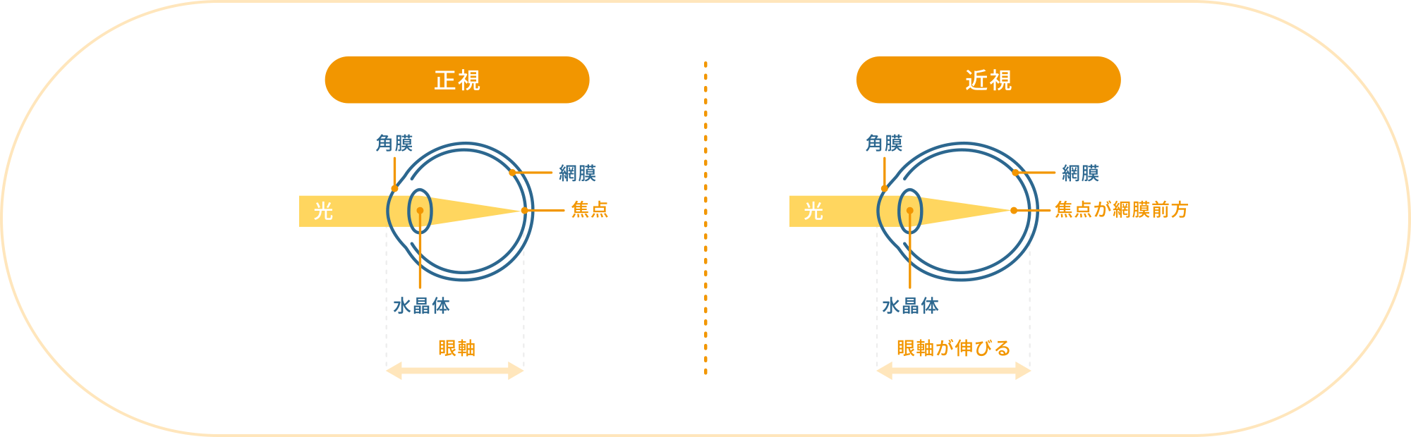 近視の仕組み