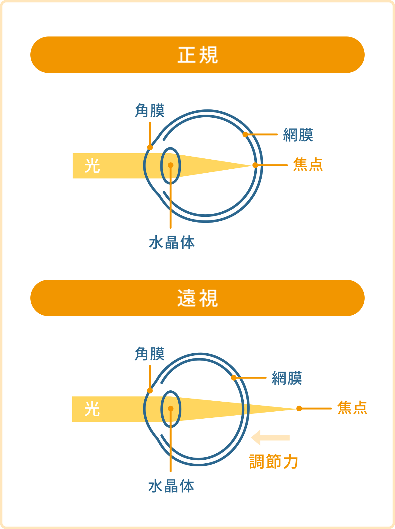 遠視の仕組み