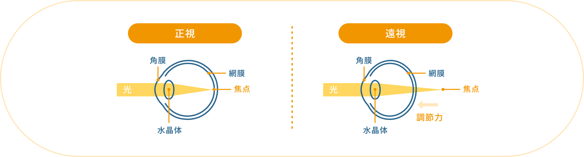 遠視の仕組み